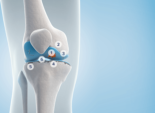 Vue intérieur d'un genou  avec l'arthrose